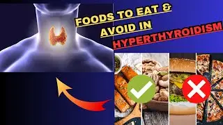 Hyperthyroidism Diet Plan | Hyperthyroidism Foods to Eat & Foods to Avoid | Hyperthyroidism Symptoms
