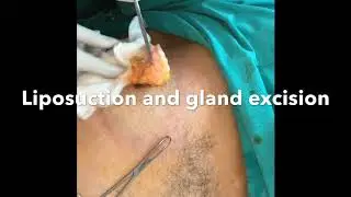 Male boobs/ enlarged Male breast Surgery