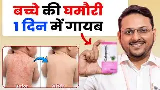 बच्चों की घमौरी कैसे ठीक करें? | बच्चों के लिए Best Baby Cream | Dr. Sandip Gupta