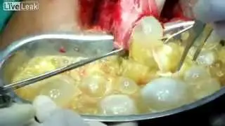 Эхинококкоз ПЕЧЕНИ (Echinococcosis of Liver)