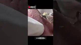 🤔 Забитые поры на носу #2