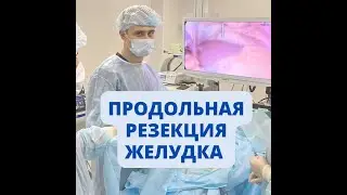Laparoscopic SLEEVE procedure