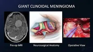 Pterional Craniotomy for Resection of a Giant Clinoidal and Cavernous Sinus Meningioma