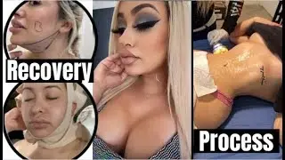 I Got 4 Surgeries At The Same Time IN MEXICO!! (RECOVERY PROCESS)