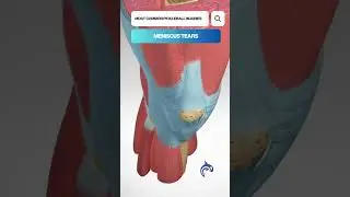 Pickleball: See the Most Common Injuries - 3D Animation 