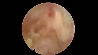 LUMBAR CANAL STENOSIS  | FULL ENDOSCOPIC SPINE SURGERY | DAYCARE SPINE SURGERY