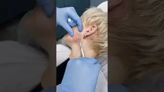 Коррекция лица гидроксиапатитом кальция.