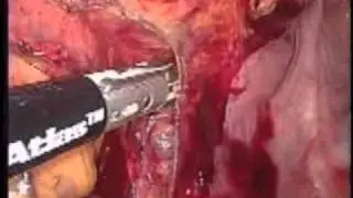 Laparoscopic Low Anterior Resection (TME) for Carcinoma of the Recto-Sigmoid Colon