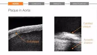 REQUEST Workflow Step 1 - Aorta