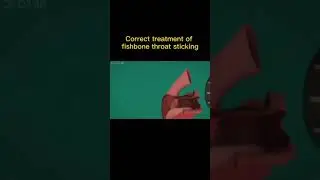 Treatment of fishbone