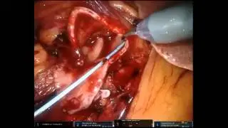 Robotic Dismembered Spiral Flap Pyeloplasty