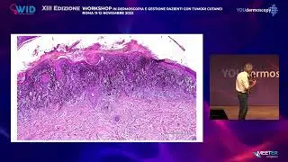 XIII Workshop - G. Argenziano - Casistica clinico patologica