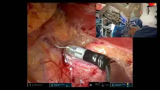 KS 174 Low Anterior Access for Retroperitoneal Single-Port Robotic Partial Nephrectomy Dr. J. Kaouk