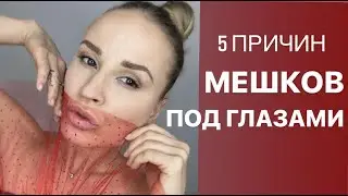 5 причин мешков под глазами