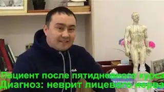 11.Неврит лицевого нерва.Лечение методом RANC в Казахстане. Отзыв пациента после лечения.