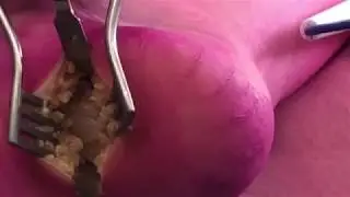 Surgical Treatment of Plantar Fasciitis