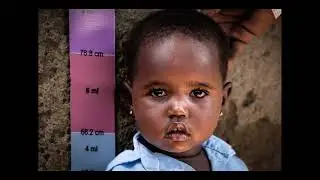 Eradicating Trachoma in Uganda - Karamoja Region