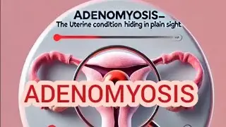 Adenomyosis—The Uterine Condition Hiding in Plain Sight