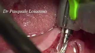impianti tilted in mandibola