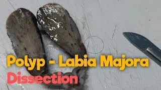 Polyp - Labia Majora Dissection