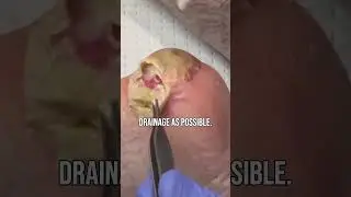 Draining an abscess