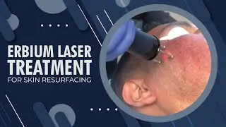 Erbium Laser Treatment for Skin Resurfacing | Beverly Hills, CA