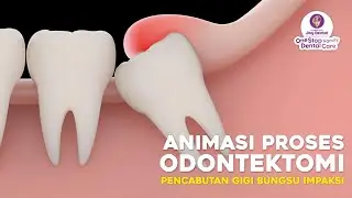 ANIMASI PROSES PENCABUTAN IMPAKSI GIGI BUNGSU ( ODONTEKTOMI )