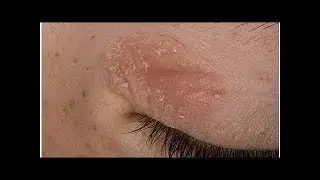 Piel seca alrededor de los ojos causas síntomas y tratamientos naturales