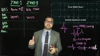 Second degree AV block simplified | The EKG Guy - www.ekgguy.com