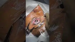 Contoura Vision Treatment 
