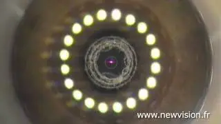 intraCOR - Traitement de la presbytie - Patient n°2 - New Vision