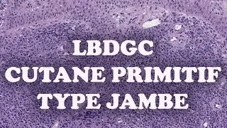 LE LYMPHOME B DIFFUS A GRANDES CELLULES CUTANE PRIMITIF TYPE JAMBE  - PATHOLOGIE