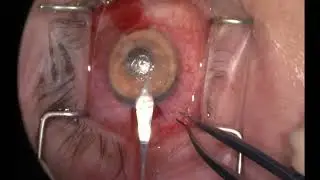 DSAEK in a patient with an Artificial Iris (HumanOptics)