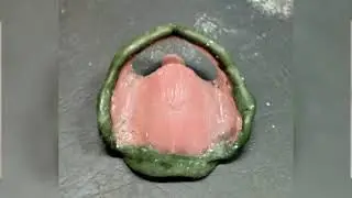 Window technique in maxillary arch