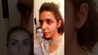 4 tips to get rid of PCOS acne! 