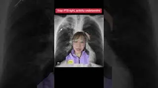 Xray: PTB, Activity Undetermine
