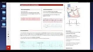 Extrasystole arrhythmias