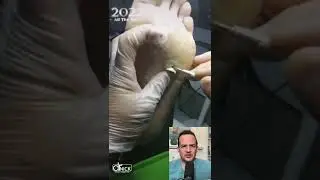 DOCTOR REACTS TO REMOVING PLANTAR WARTS! 😱 #shorts #reaction
