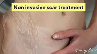 Non Invasive C Section Scar Treatment | Reusable Medical Grade C-Section Silicone Strips