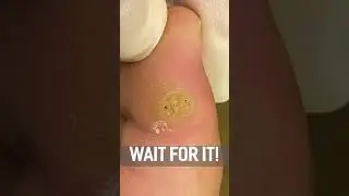 GIANT WART IN BIG TOE!! 😳🤯 