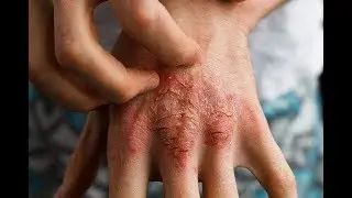Psoriasis behandelen met sarsaparilla
