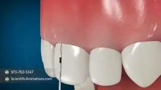 Esthetical Crown Lengthening Animation | Dental Animation