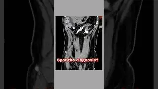 Spot the d/s from the CECT abdomen section given. #youtubeshorts #trending #viral #study #video