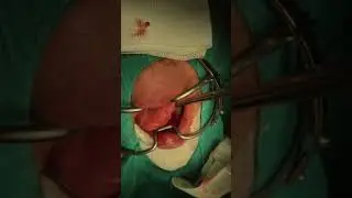 Tükrük Bezi Taşı