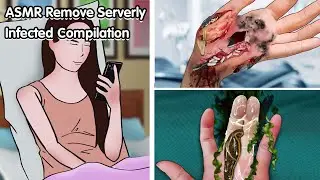 ASMR Remove Serverly Infected Compilation - Deep Cleaning Animation