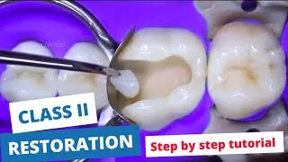 ❓️how to do composite restoration | filling posterior molar teeth | Dental education | your dentist