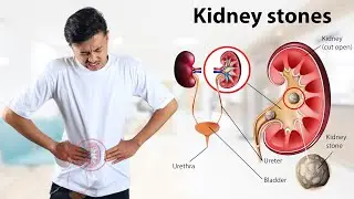 Kidney Stone की समस्या से परेशान लोगों के लिए RIRS एक सुरक्षित और प्रभावी विकल्प है। Dr. Neel Patel