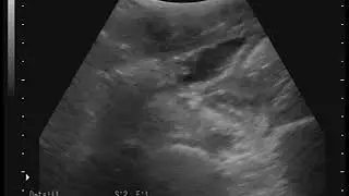 Equine Ascarid Infection - Ultrasound | Merck Veterinary Manual