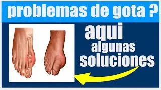 remedios contra la gota ¡Adiós Gota! 5 Remedios para tratarla