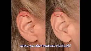 Image Guided Superficial Radiation Therapy - This Week at Haber Dermatology